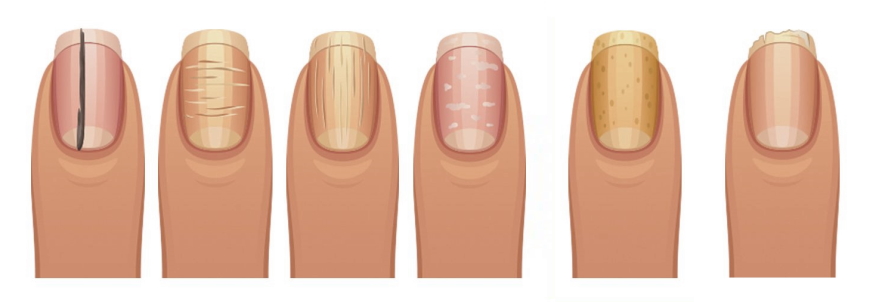 Dear Dr Jennifer: Why are my daughter's nails so weak and brittle? |  Independent.ie